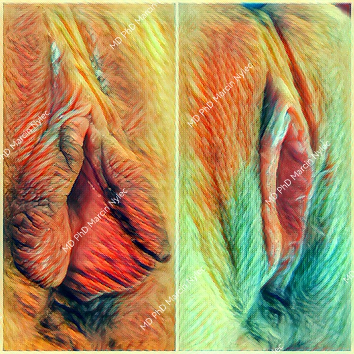 labioplastyka rzeszów pacjentka 11