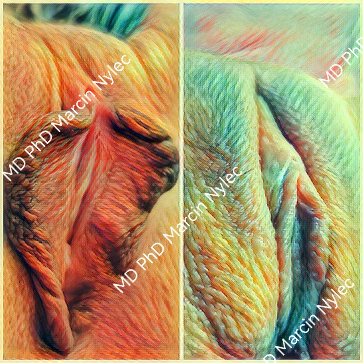 labioplastyka rzeszów pacjentka 5