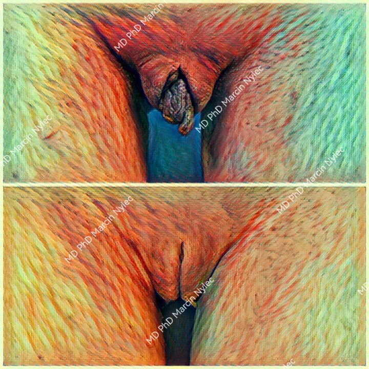 labioplastyka rzeszów pacjentka 7